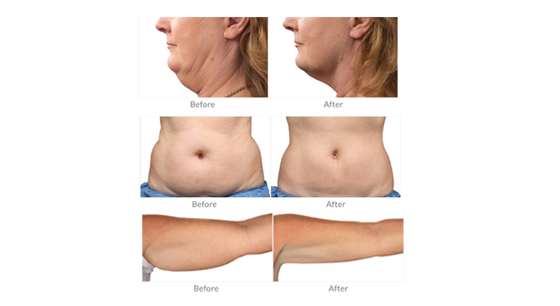 prezzo della macchina per criolipolisi