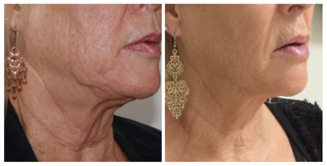 Hifu 3D Face Lift Corea 3 in 1 Hifu Skin Tightening Beauty Machine