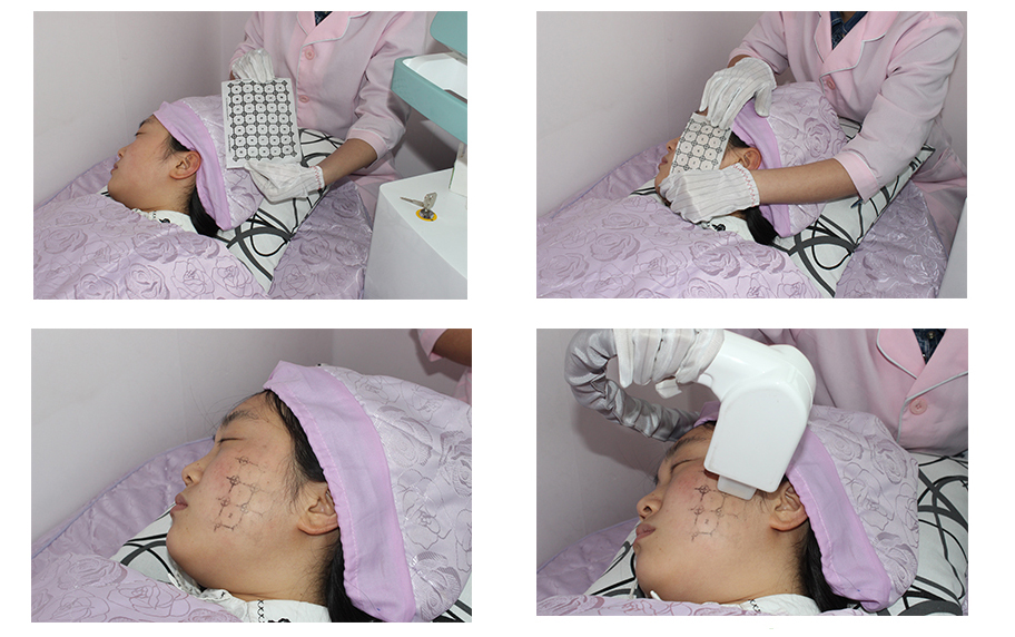 Thermage Fractional RF dispositivo antinvecchiamento