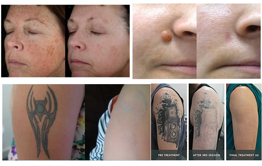 rimozione del tatuaggio