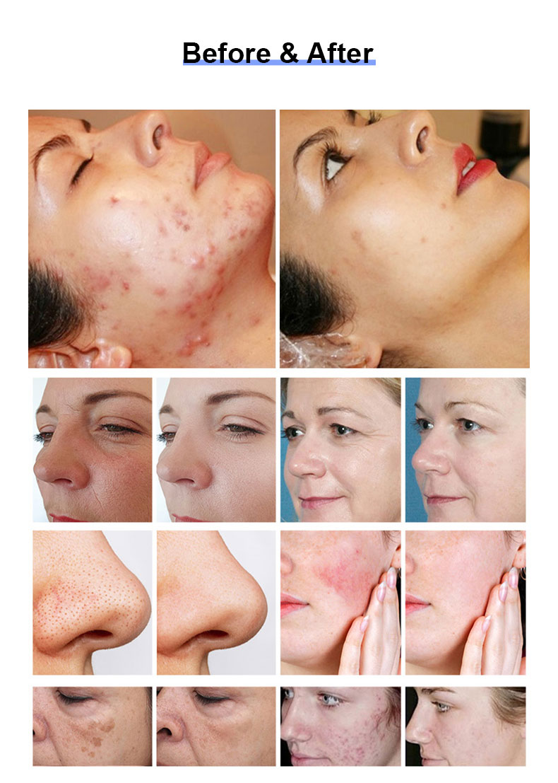 Laser frazionario di THULIO 1927nm