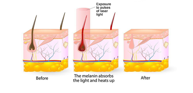 macchina per la depilazione laser