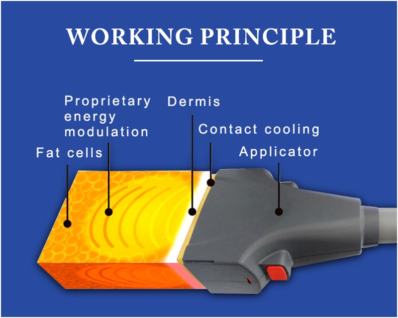 Principio di funzionamento di SculpSure