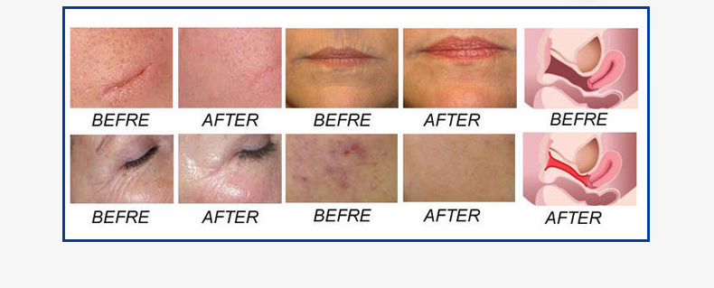 Macchina laser frazionaria professionale di CO2