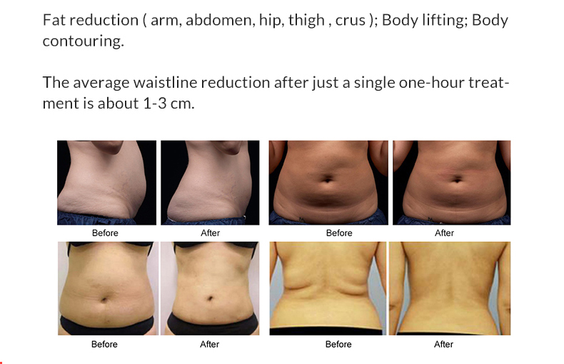 Macchina per dimagrire il corpo Hifu Liposonix