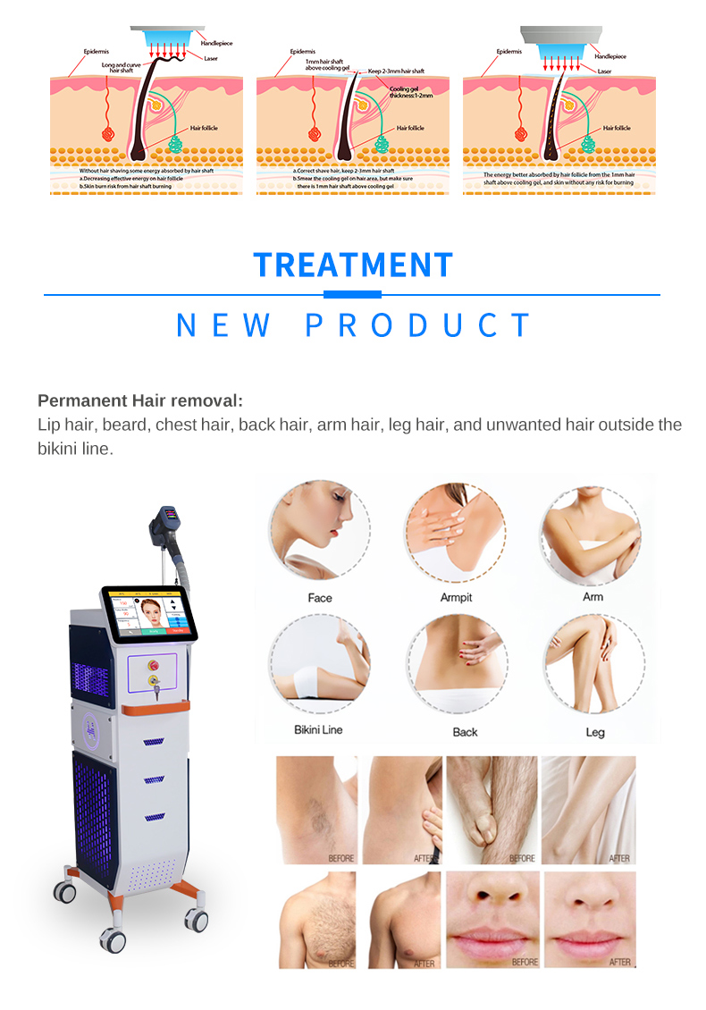 Depilazione laser a diodi