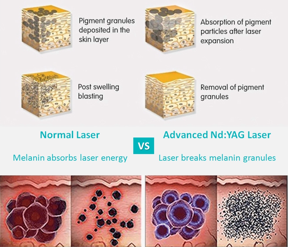rimozione del pigmento