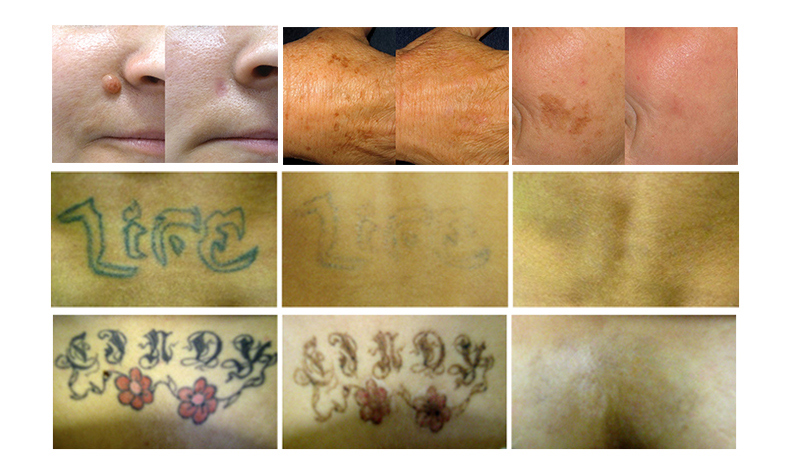 Macchina per la rimozione del tatuaggio