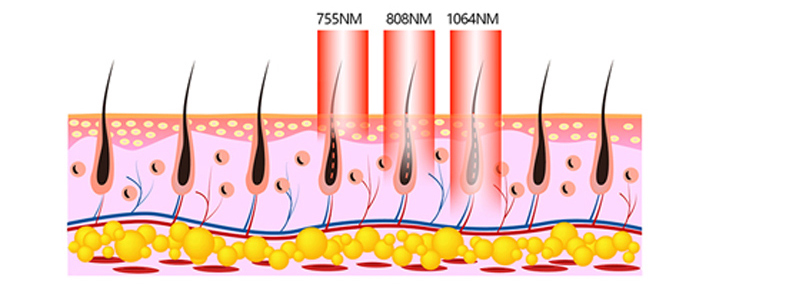 Teoria della macchina per la depilazione dei capelli