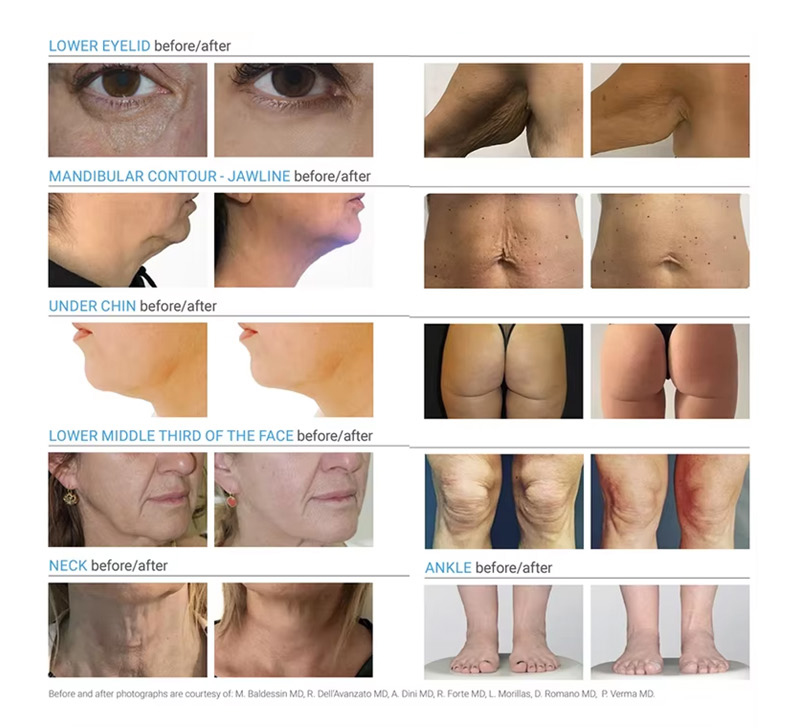 macchina lipolisi laser a diodi