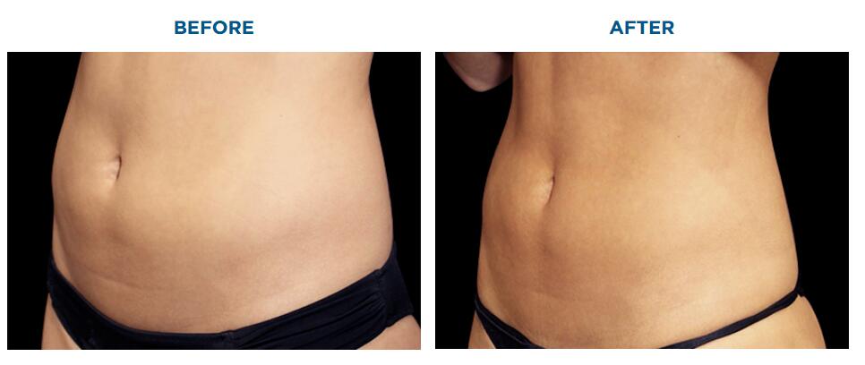 macchina per la perdita di peso