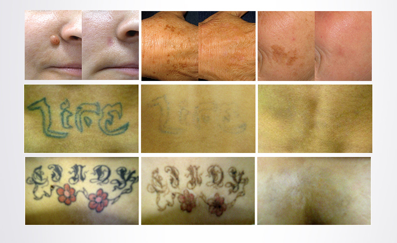 Approvazione CE Laser Beauty Equipment rimozione del tatuaggio q commutato e yag prezzo lase