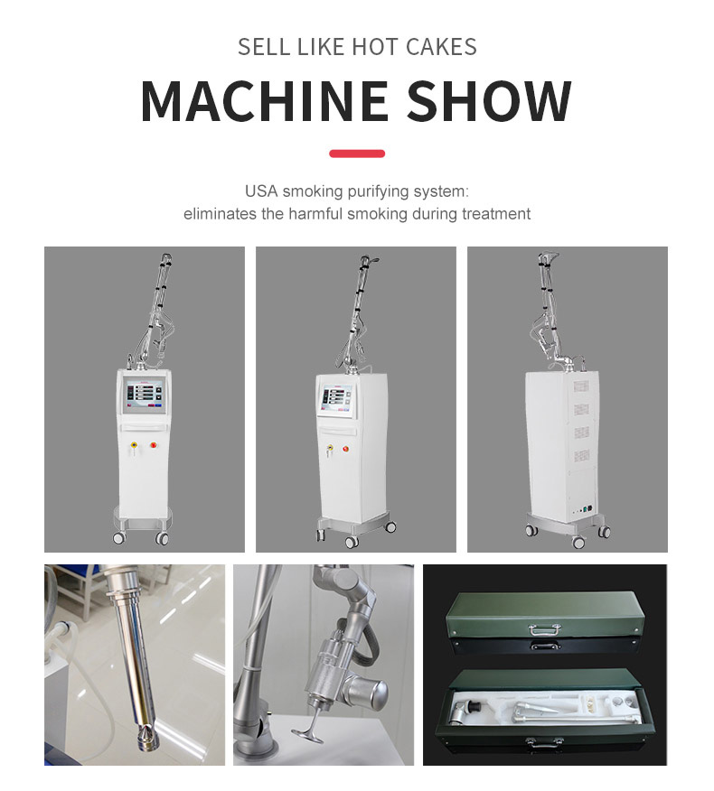 Smagliature rimozione dell'acne