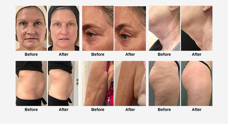 macchina per la rimozione delle rughe per hifu