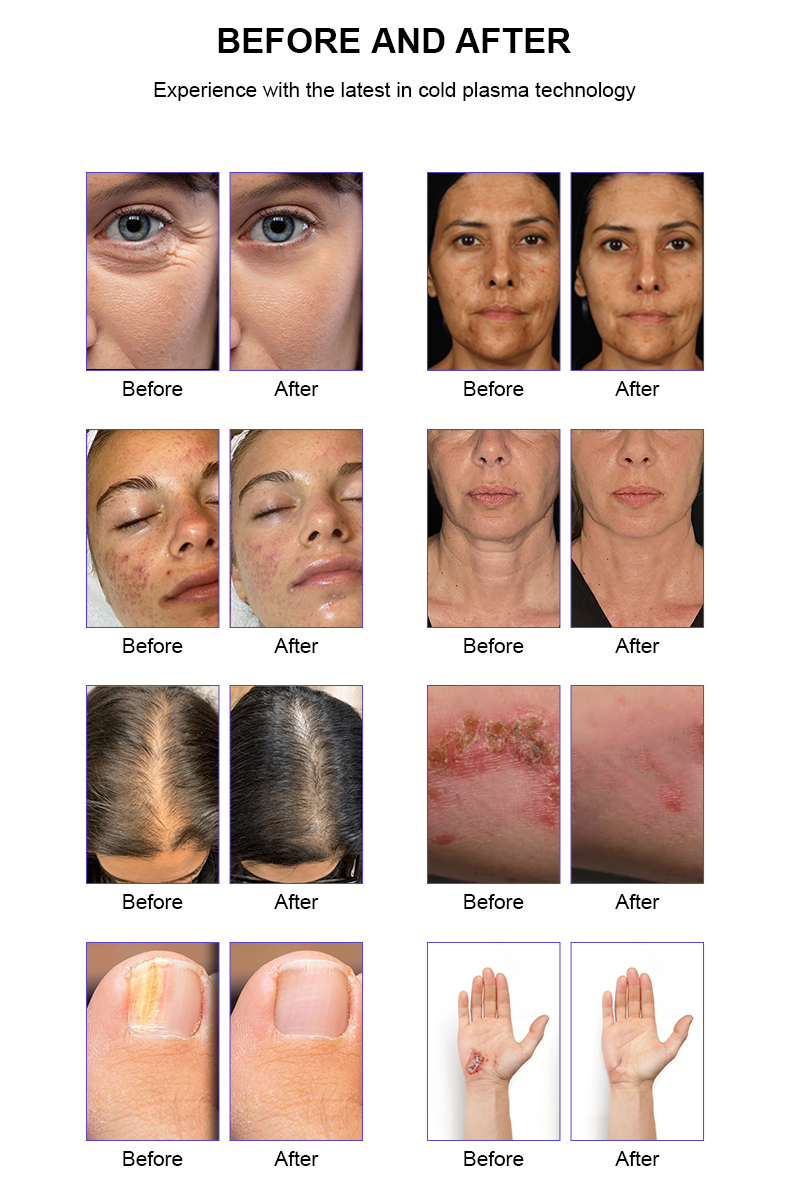 Macchina per plasma freddo