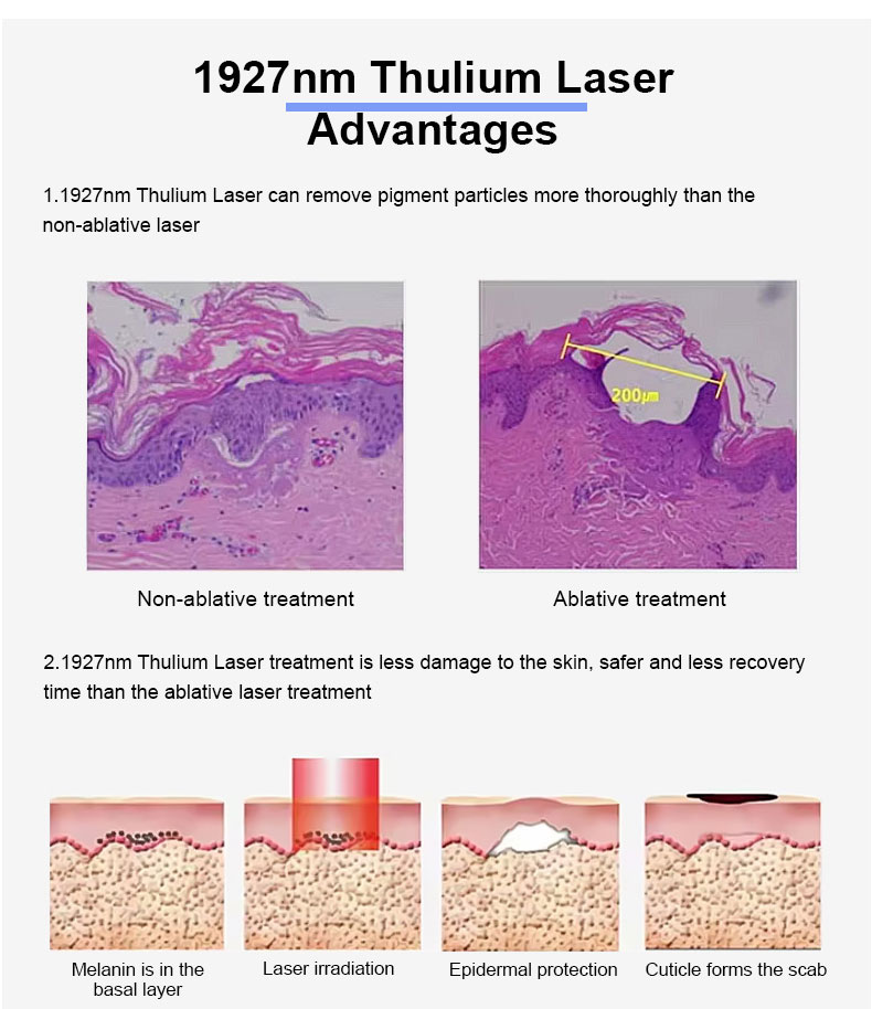 1927nm Laser frazionario di tulium