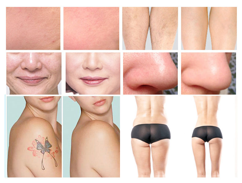 E-luce + Laser NdYAG+lipolaser+RF