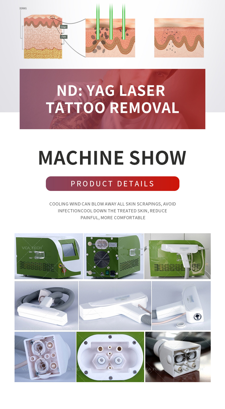 macchina per rimozione del tatuaggio laser 