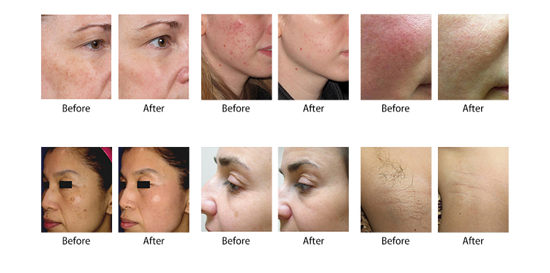 Macchina per il ringiovanimento della pelle