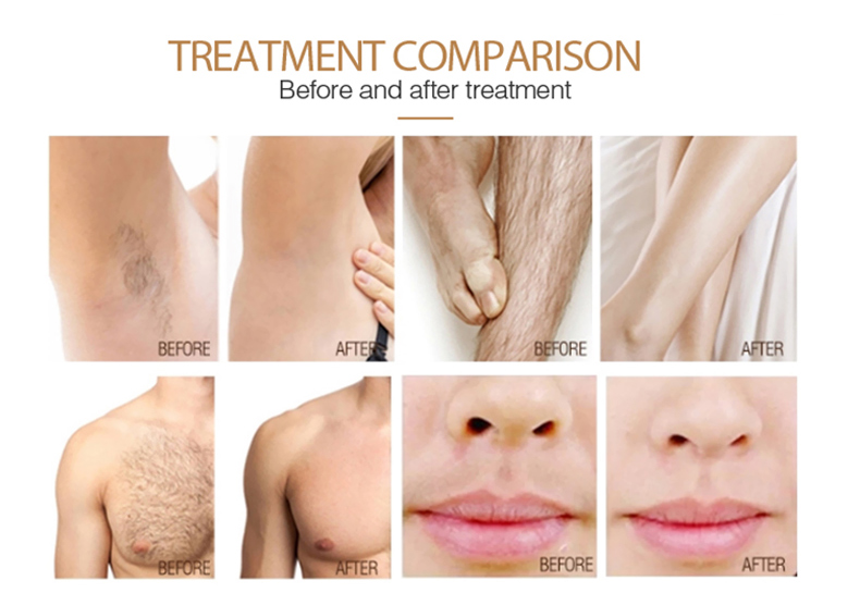 Macchina a diodo per la depilazione laser