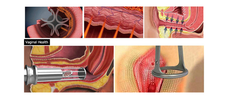 Macchina laser frazionaria professionale di CO2