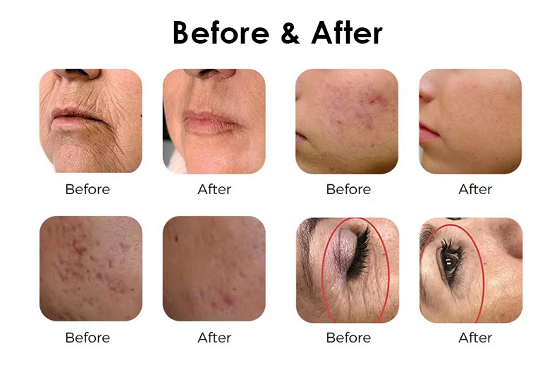 Vetro erbio da 1550 nm&nbsp; Laser&nbsp;