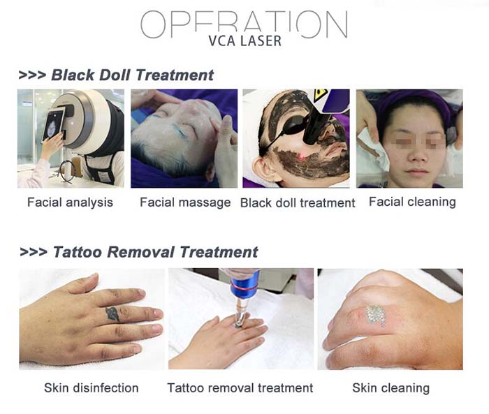 rimozione del tatuaggio pico