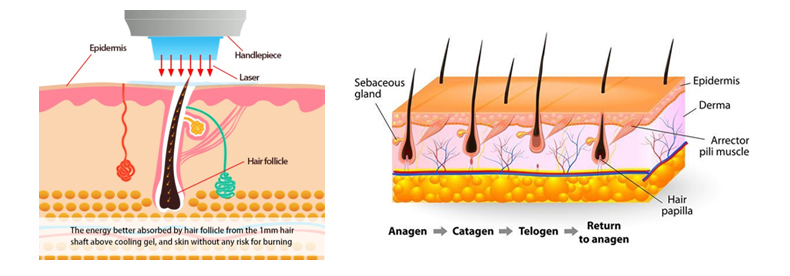 Depilazione dei capelli laser 