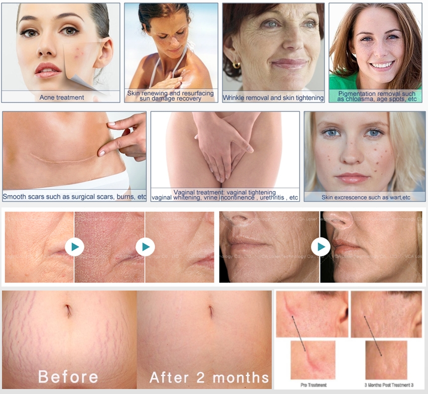 Laser Co2 frazionato