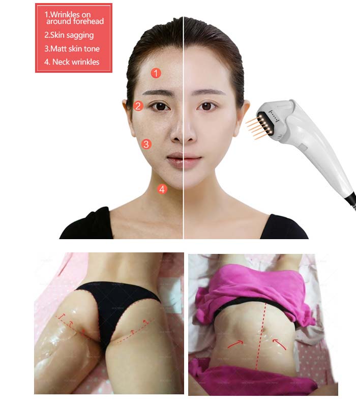 macchina per la rimozione delle rughe