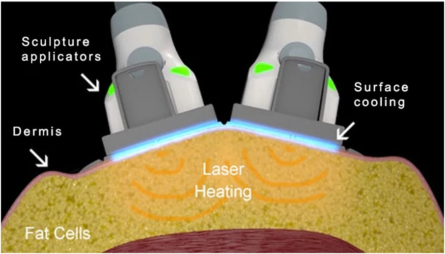 Teoria del funzionamento di SculpSure