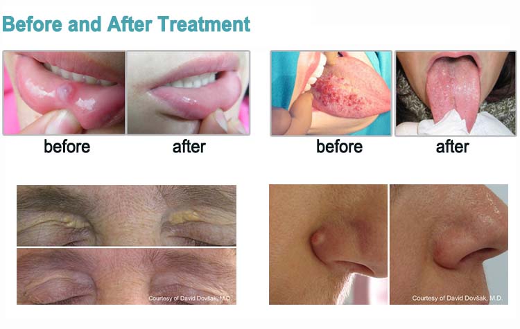 stretta vaginale con CO2 frazionata