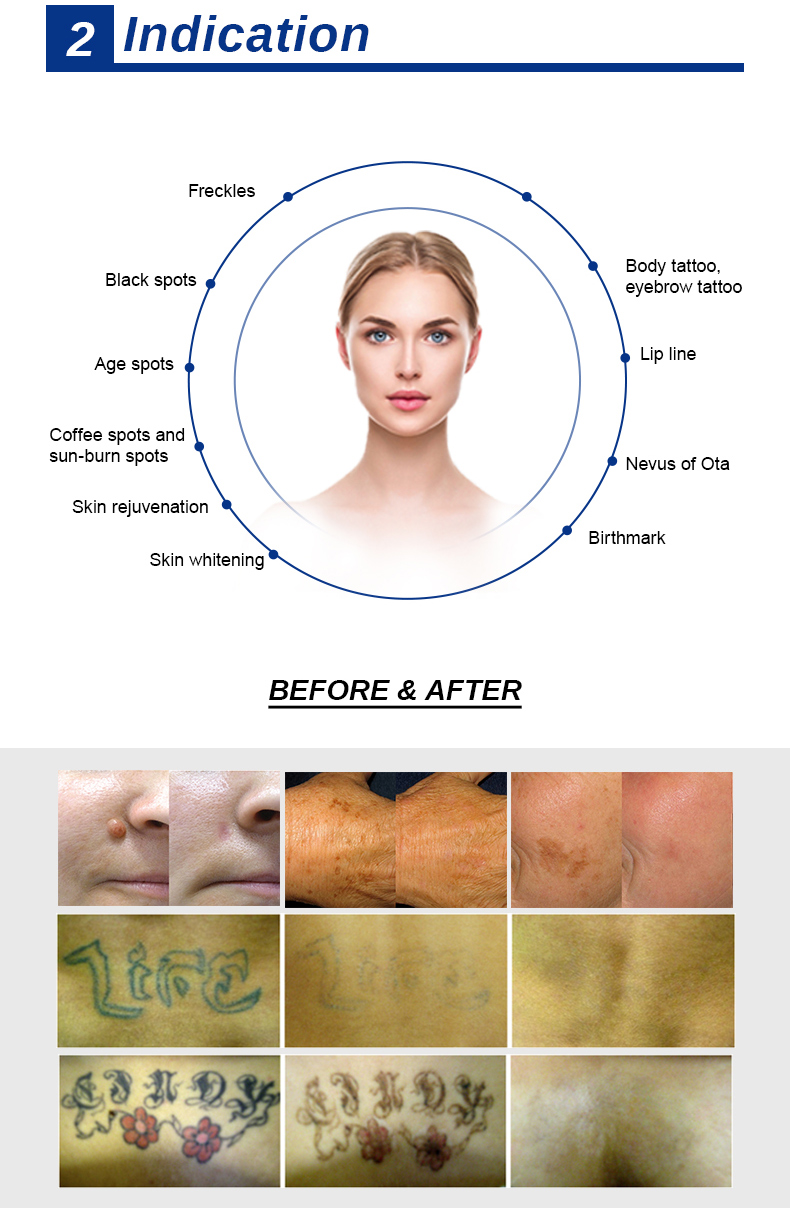 Rimozione del tatuaggio laser