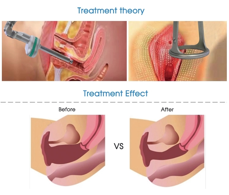 laser per il rafforzamento vaginale