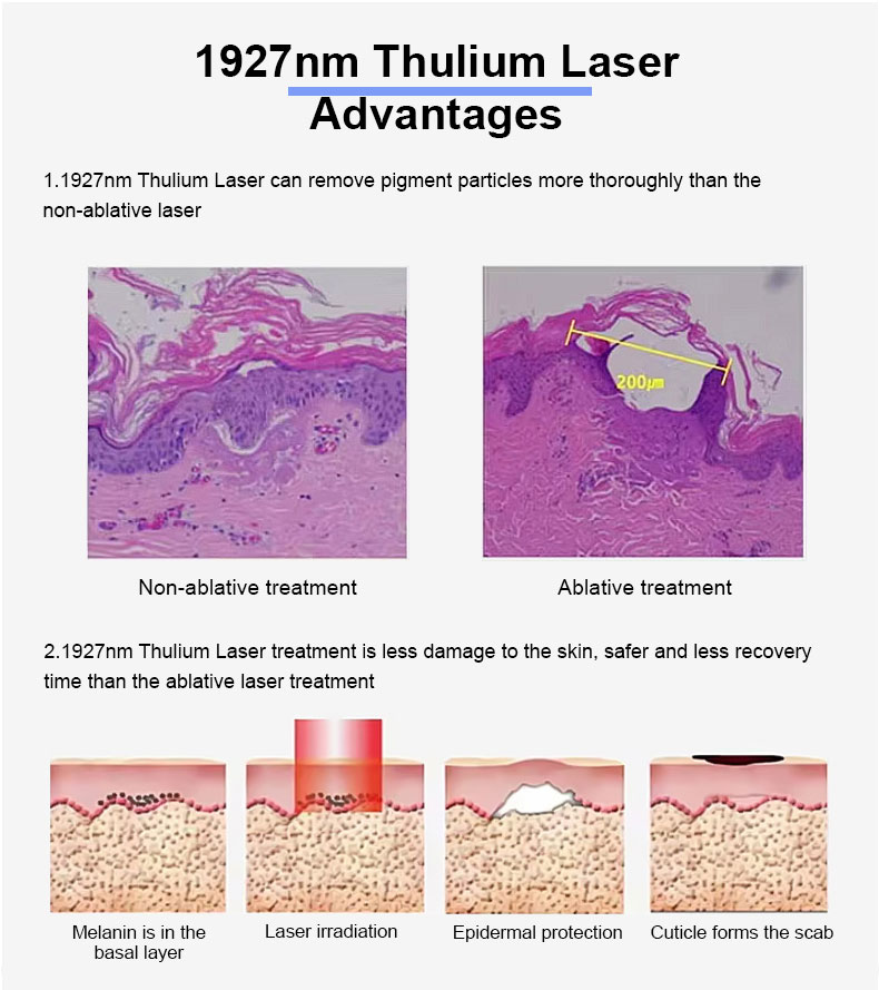 Laser frazionario di THULIO 1927nm