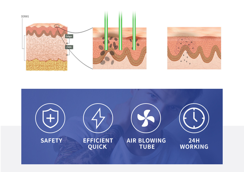 Macchina per la rimozione del tatuaggio