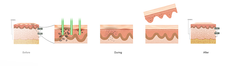 macchina laser per rimozione del tatuaggio