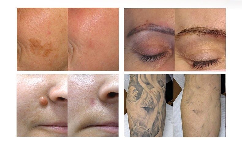 macchina laser per rimozione del tatuaggio